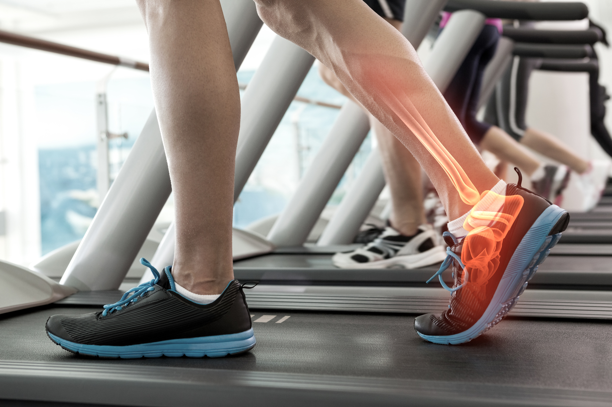 Runner holding lower leg in pain from shin splints during outdoor run